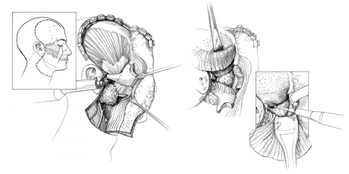 Shiere Melin, pen and ink illustration, nasolarynx tumor